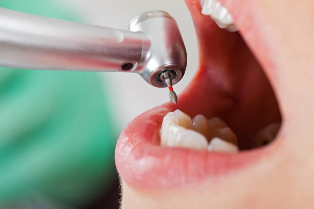 Best Knocked-Out Tooth (Avulsed Tooth) Treatment in Omaha, TX
